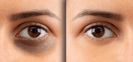 3 Easy DIY Packs to Reduce Dark Under Eye Circles Naturally